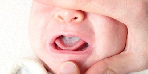 Молочница у новорожденных детей во рту