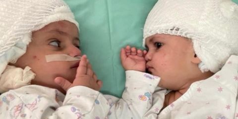 Срослись черепами: в Израиле 12 часов оперировали сиамских близнецов
