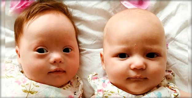 «Один шанс на миллион»: необыкновенные близнецы родились в британской семье