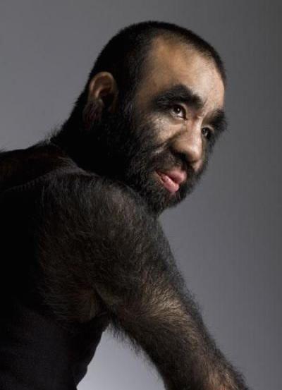 «Человек-обезьяна» как самый волосатый мужчина на планете нашел свою любовь