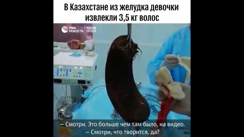 Казахские медики достали из желудка девочки около 3,5 килограмм волос