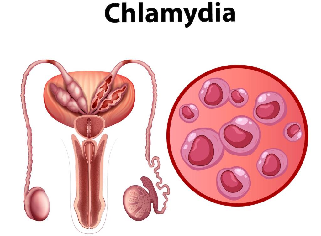 Бесплодие из-за хламидиоза: как вылечить и как не допустить?