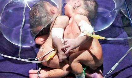 В Индии родились сиамские близнецы с одним сердцем на двоих