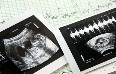В Беларуси за 10 лет количество абортов снизилось в 6,5 раза