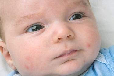 Сыпь у новорожденных детей: виды, причины, лечение