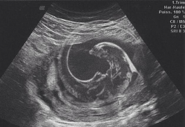 Отец подделал снимок с УЗИ малыша, заменив его изображение на фото инопланетянина. Первое время никто не замечал подмену