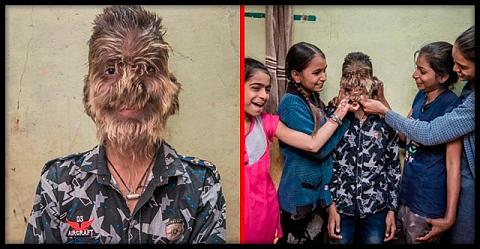 “Индийский оборотень”: как живет 13-летний мальчик, чье лицо покрыто волосами